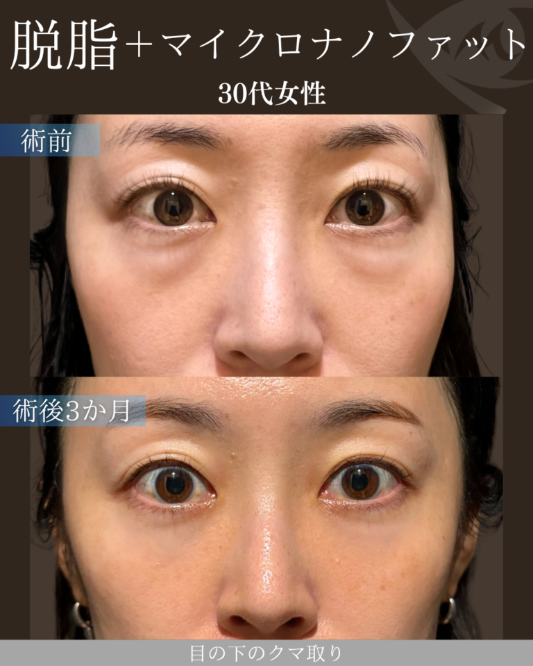 30代女性 脱脂＋マイクロナノファット 術後3ヶ月